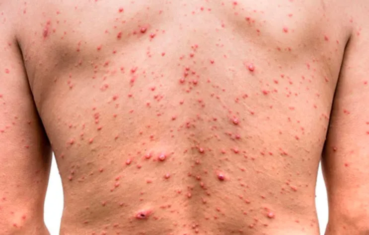viruela simica